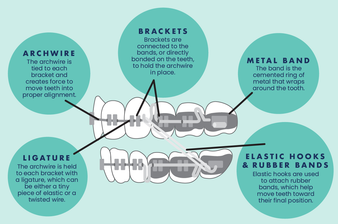 Explaining the Different Parts of Braces  River Falls Orthodontics - Braces  & Invisalign